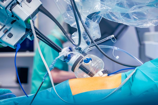 Nahaufnahme eines Roboter-Operationssystems, das Instrumente über einen klaren Trokar in den Bauch eines Patienten einführt.